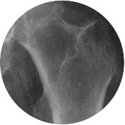 fracture-pathologique-hanche